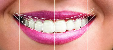 Smile Designing