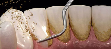 Teeth Cleaning Treatment