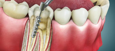 Tooth Filling and Restoration
